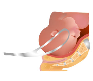 forcep birth injuries Clark, NJ