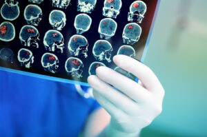 Colonia High School Linked to Rare Brain Tumor 